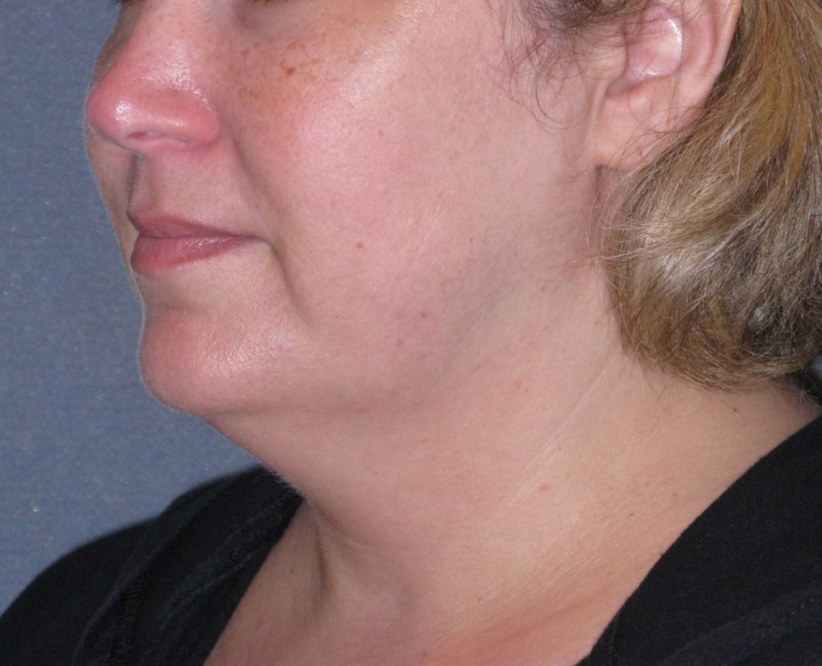 Lower Face & Neck Lifting Before & After Gallery - Patient 299080 - Image 3