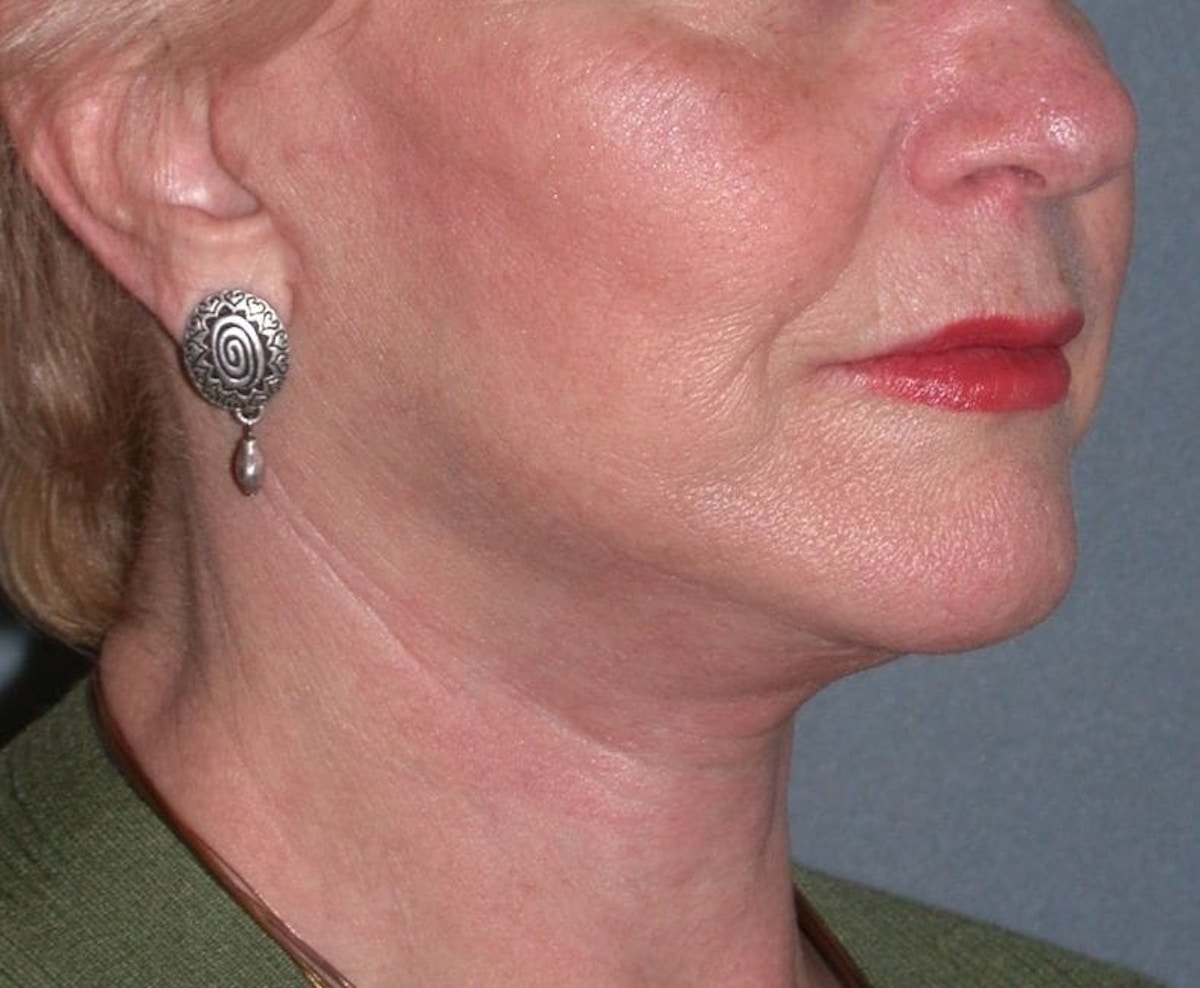 Lower Face & Neck Lifting Before & After Gallery - Patient 361711 - Image 4
