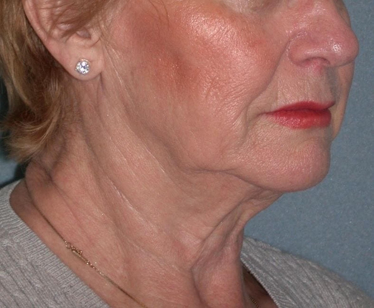 Lower Face & Neck Lifting Before & After Gallery - Patient 361711 - Image 3