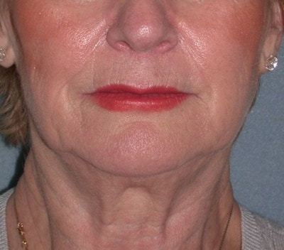 Lower Face & Neck Lifting Before & After Gallery - Patient 361711 - Image 1