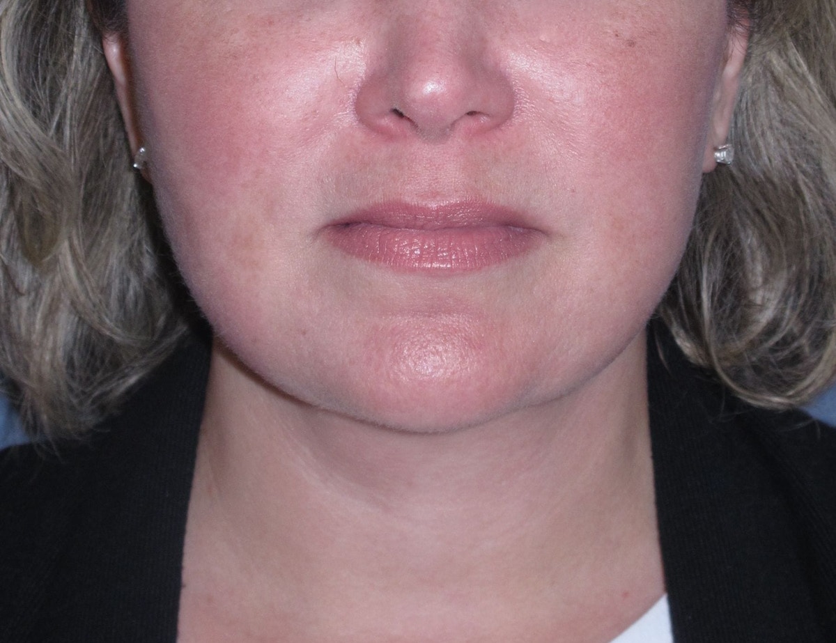 Lower Face & Neck Lifting Before & After Gallery - Patient 299080 - Image 2