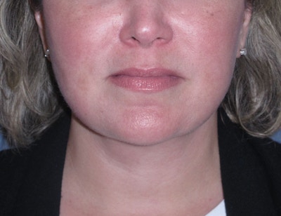 Lower Face & Neck Lifting Before & After Gallery - Patient 299080 - Image 2