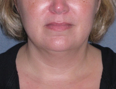 Lower Face & Neck Lifting Before & After Gallery - Patient 299080 - Image 1