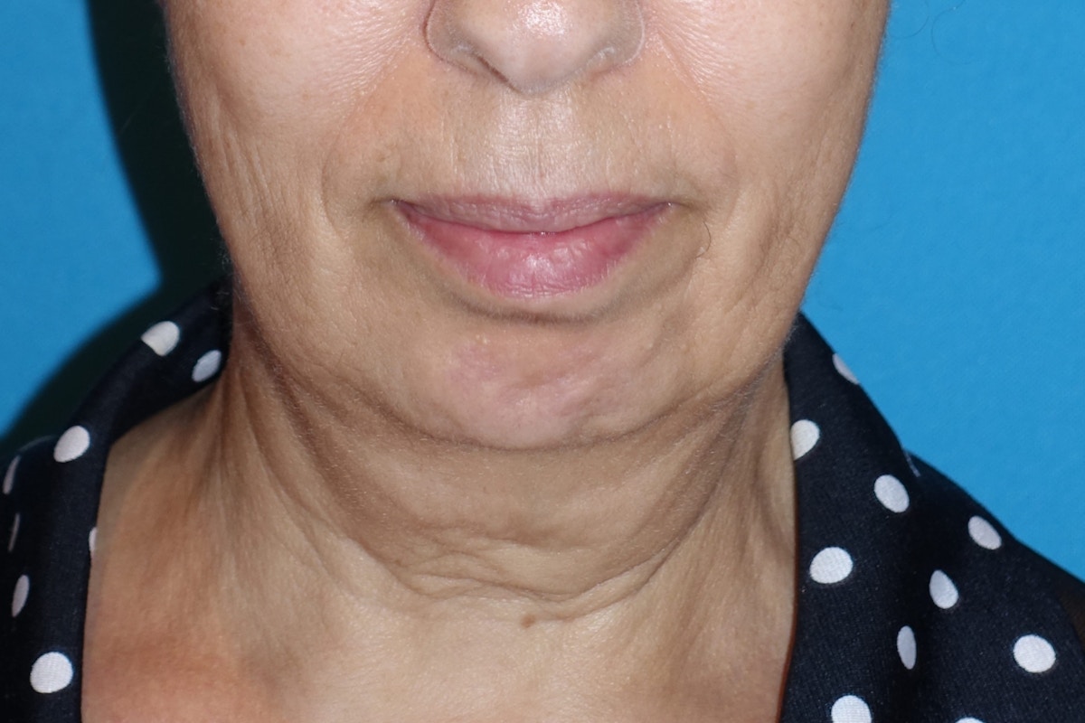 FaceLift Before & After Gallery - Patient 378796 - Image 1