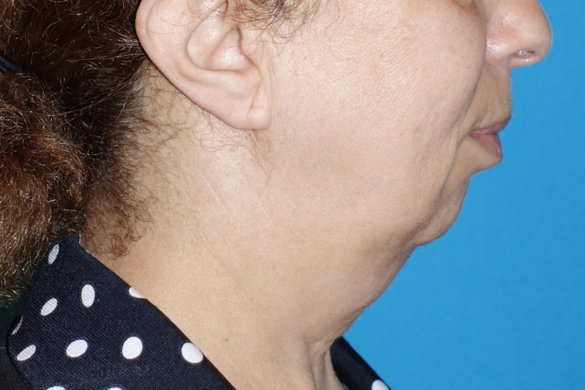 FaceLift Before & After Gallery - Patient 378796 - Image 7