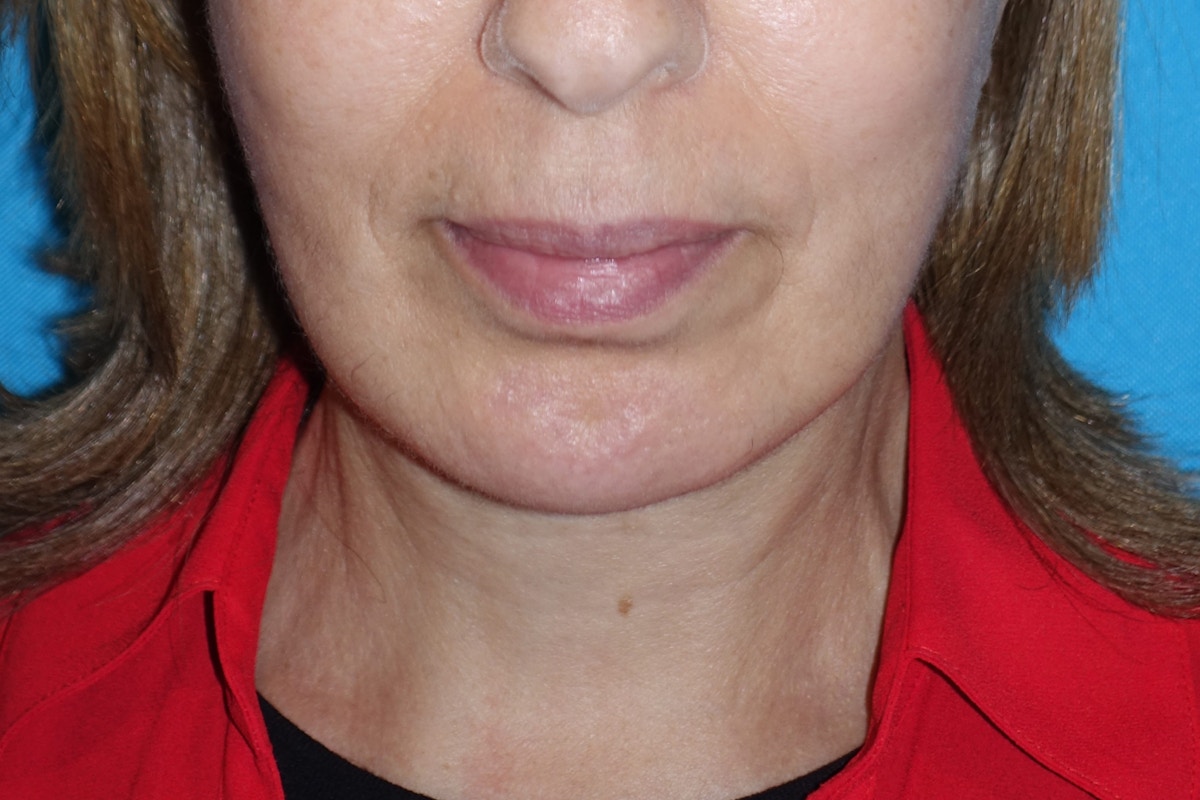 FaceLift Before & After Gallery - Patient 378796 - Image 2