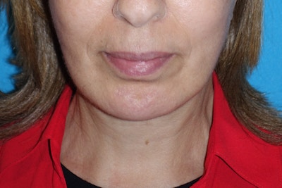 Lower Face & Neck Lifting Before & After Gallery - Patient 381137 - Image 2