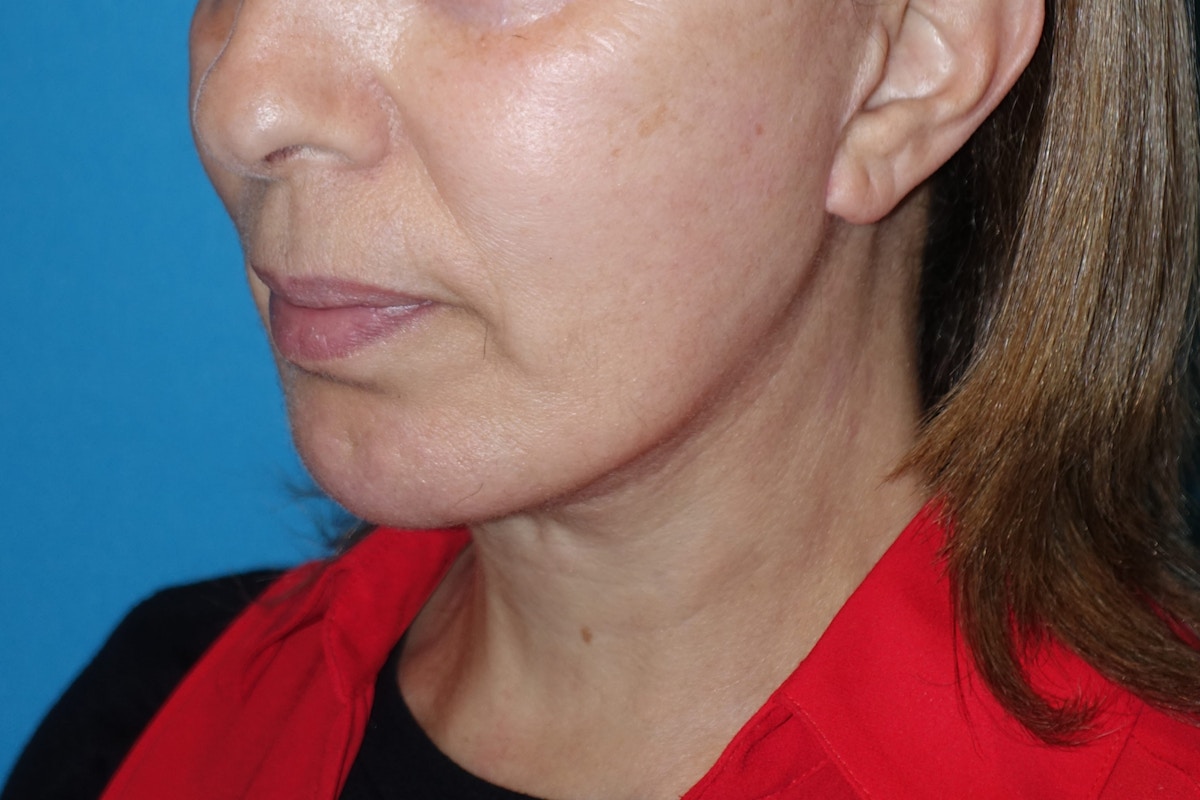 FaceLift Before & After Gallery - Patient 378796 - Image 6