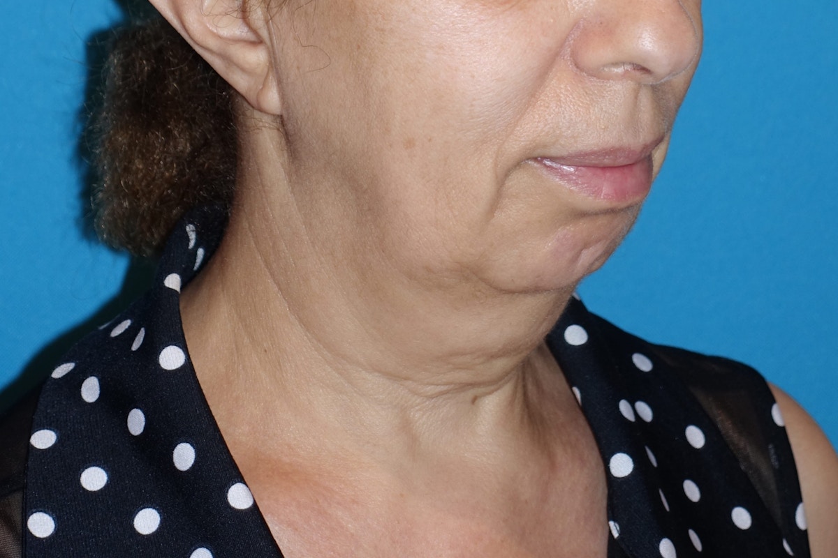 FaceLift Before & After Gallery - Patient 378796 - Image 3