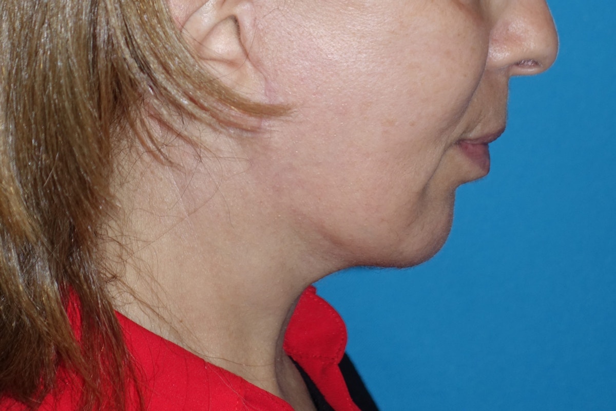 FaceLift Before & After Gallery - Patient 378796 - Image 8