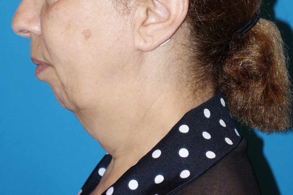 FaceLift Before & After Gallery - Patient 378796 - Image 9