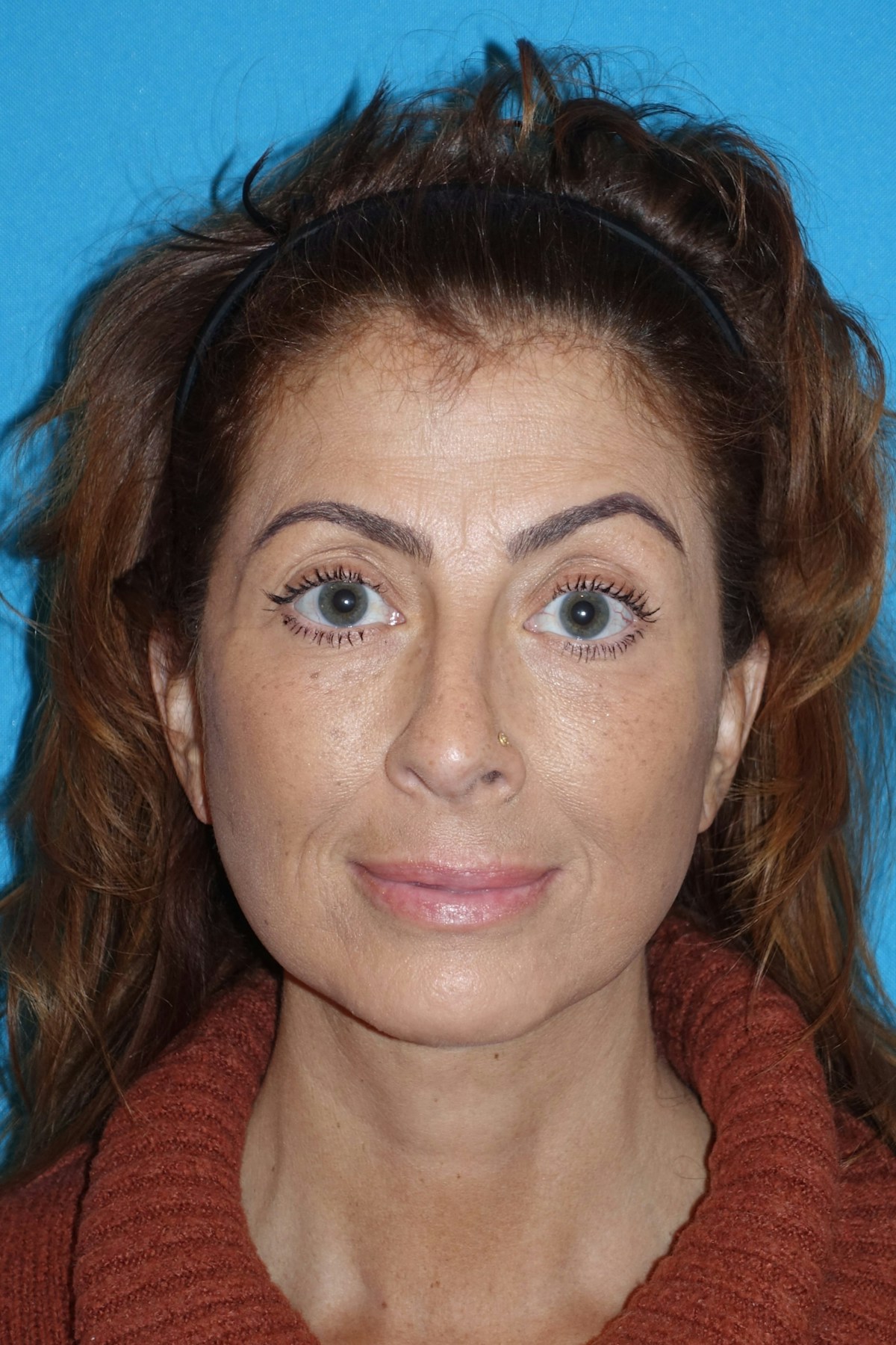 FaceLift Before & After Gallery - Patient 214907 - Image 2