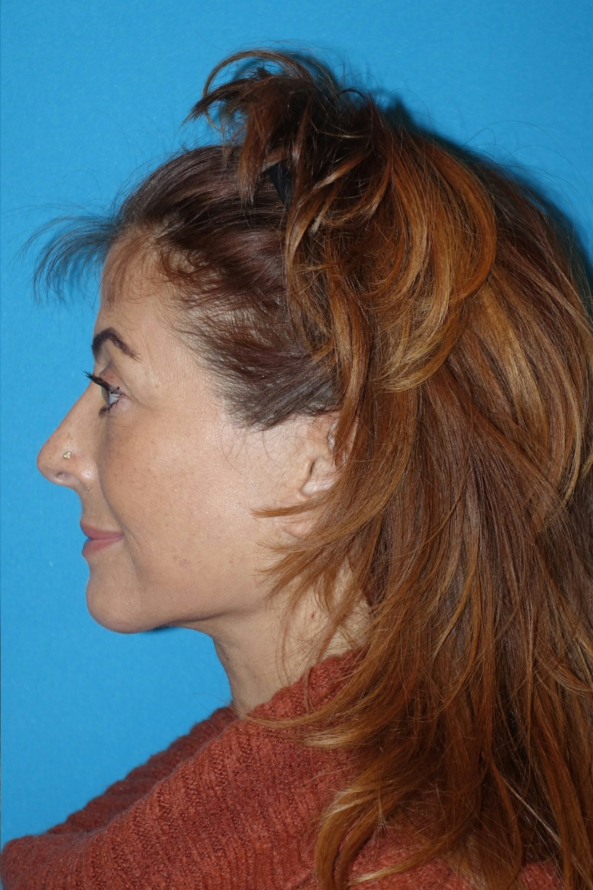 FaceLift Before & After Gallery - Patient 214907 - Image 8