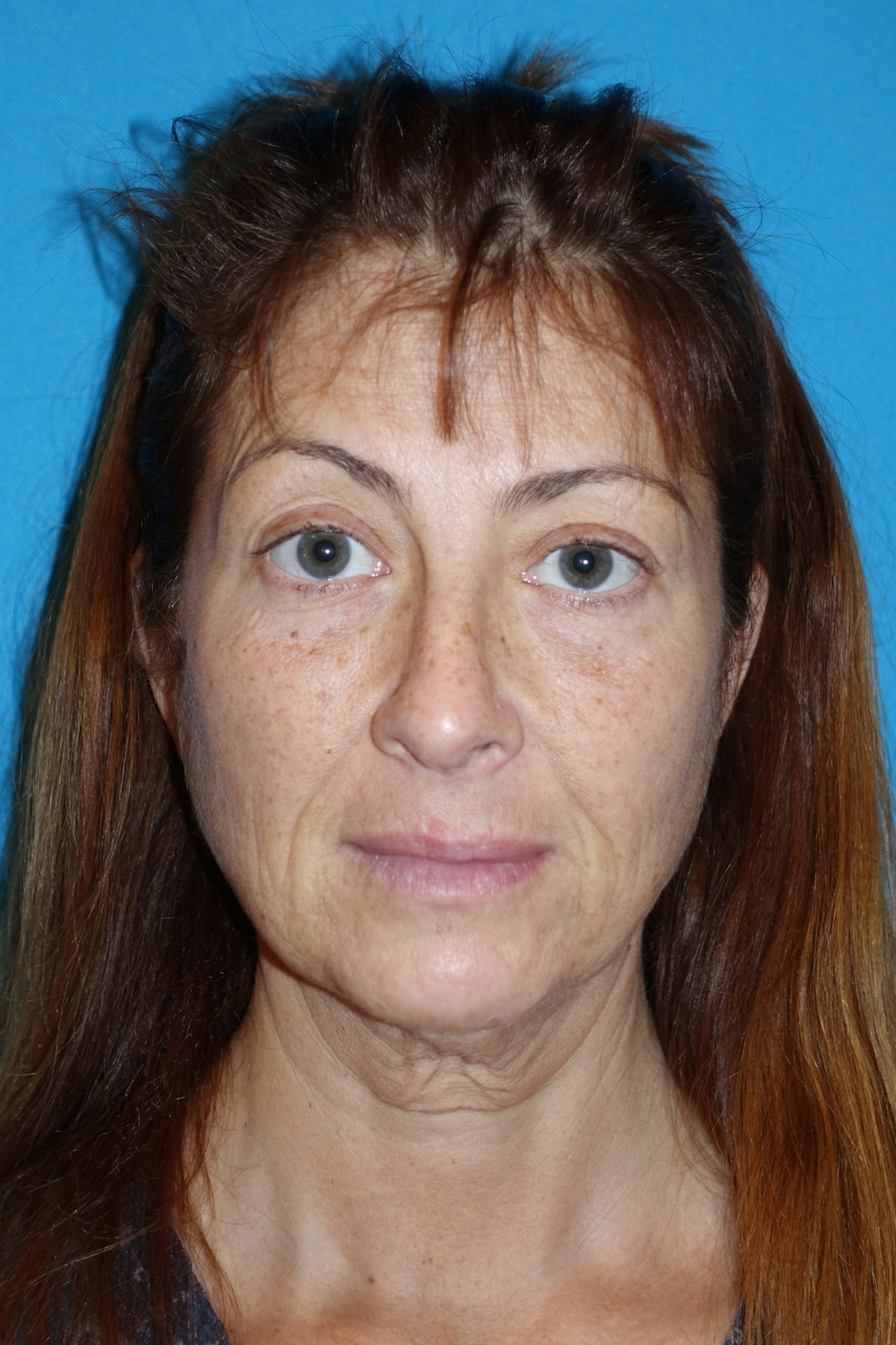 FaceLift Before & After Gallery - Patient 214907 - Image 1