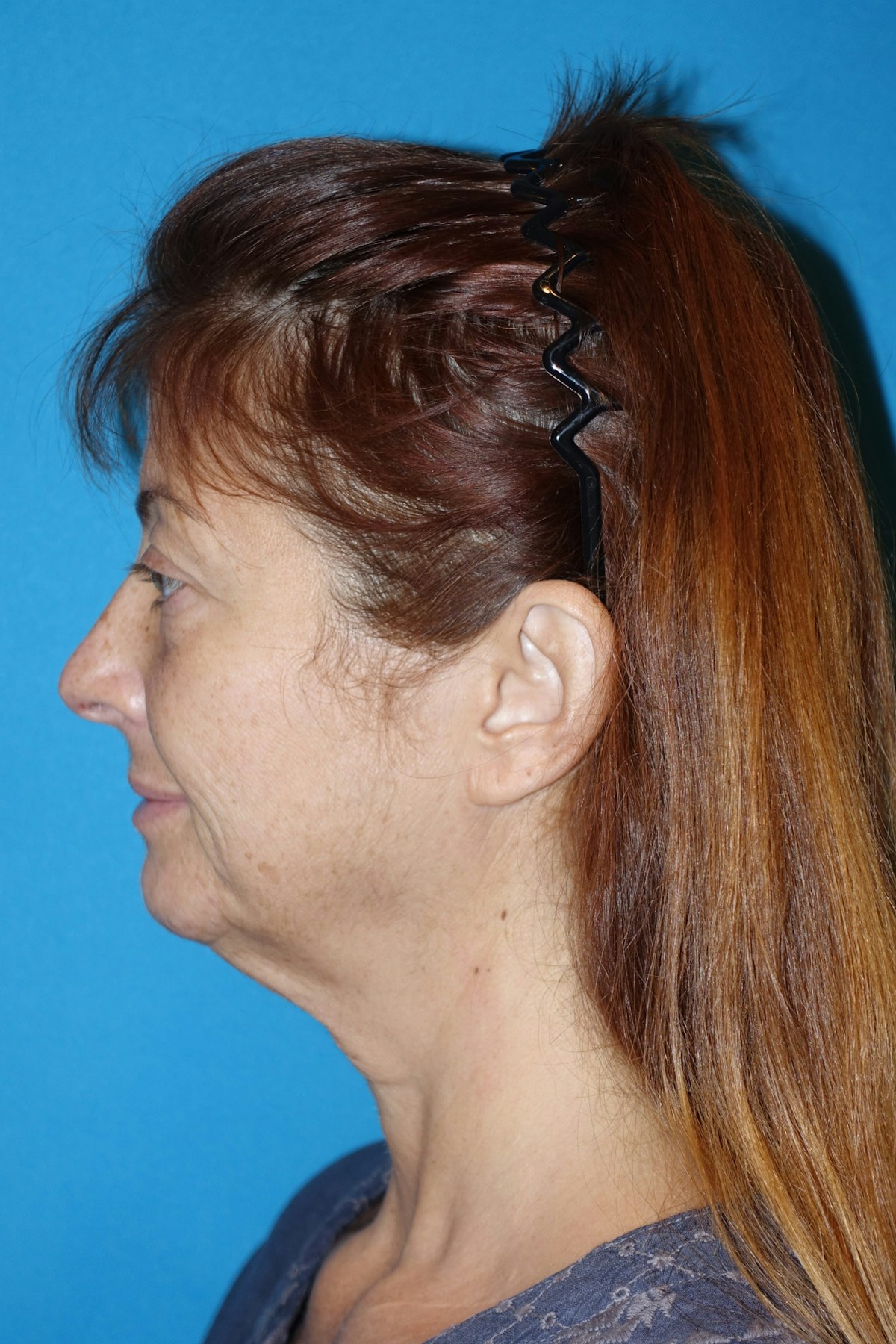 FaceLift Before & After Gallery - Patient 214907 - Image 7