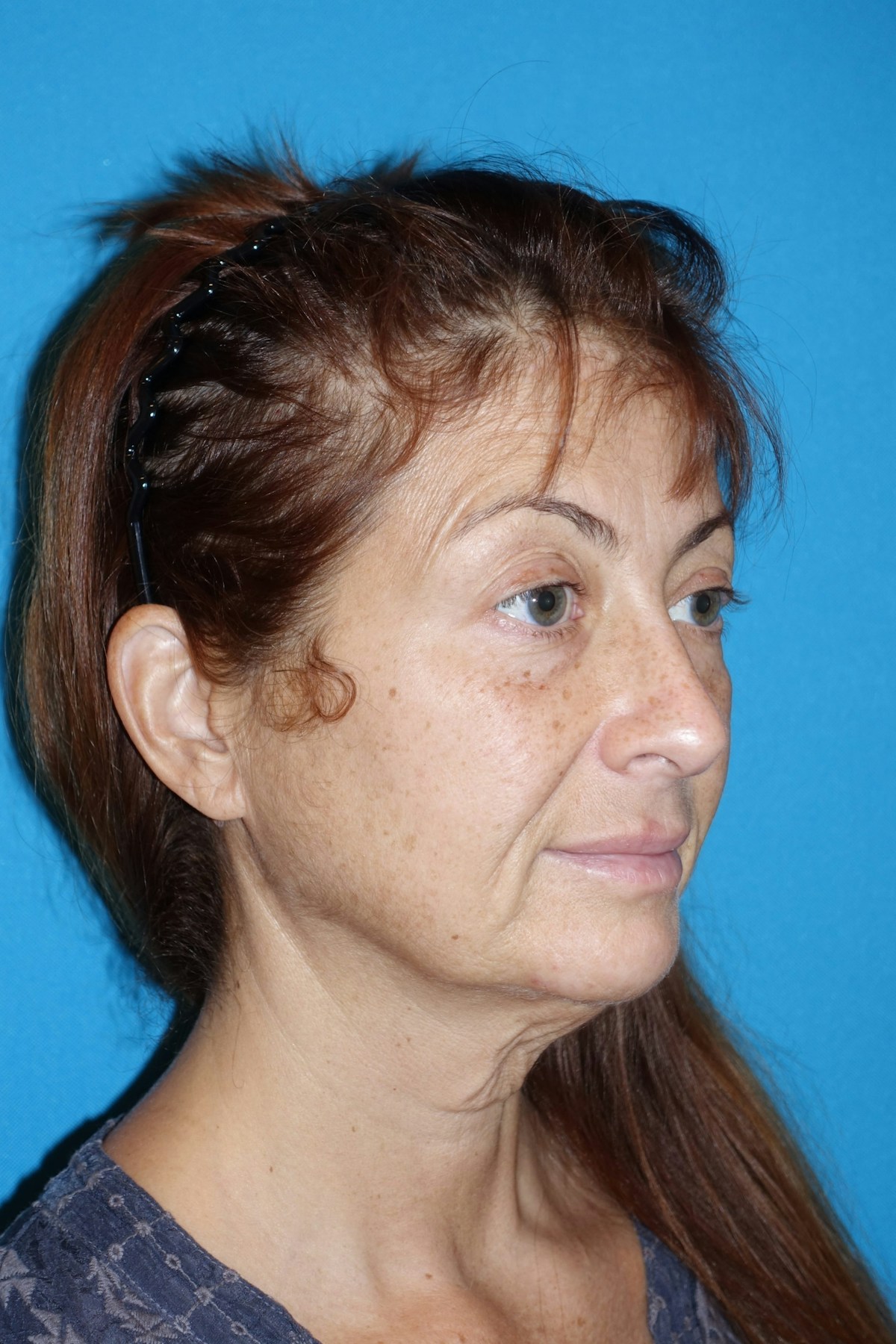 FaceLift Before & After Gallery - Patient 214907 - Image 5