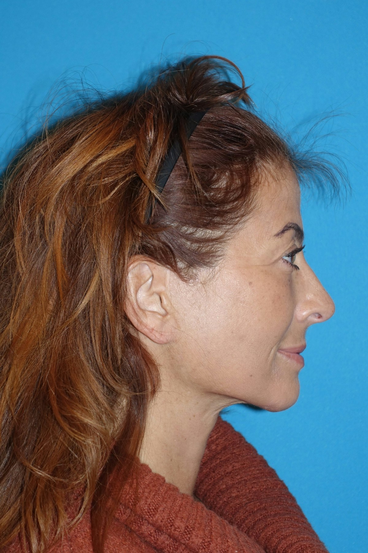 FaceLift Before & After Gallery - Patient 214907 - Image 10