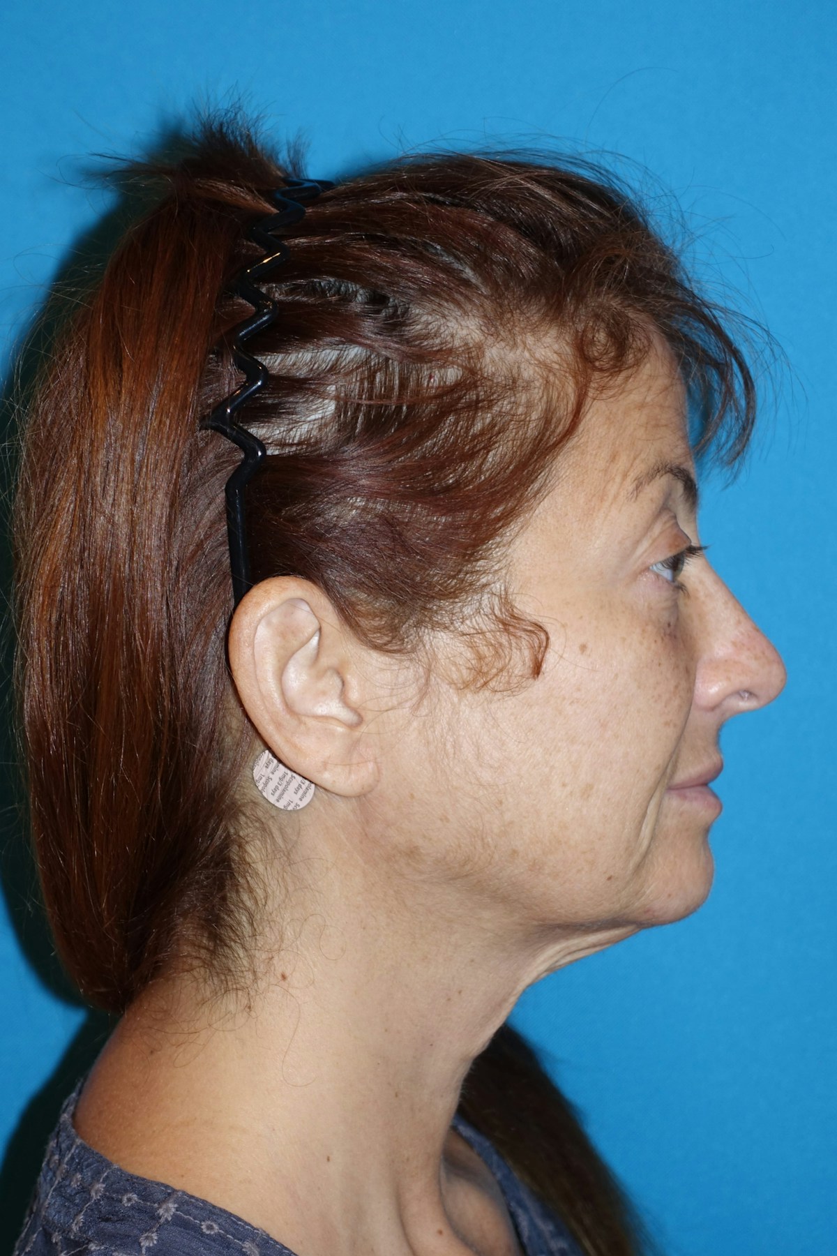 FaceLift Before & After Gallery - Patient 214907 - Image 9