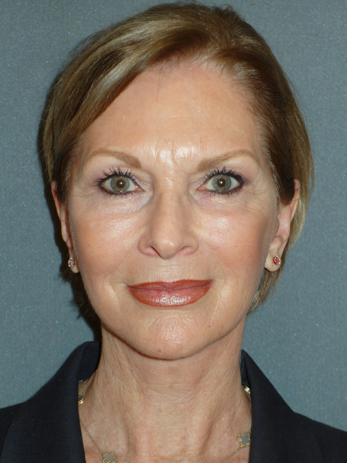 Lower Face & Neck Lifting Before & After Gallery - Patient 329261 - Image 2