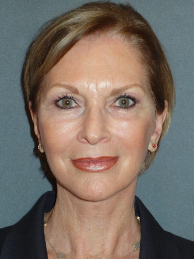Lower Face & Neck Lifting Before & After Gallery - Patient 329261 - Image 2