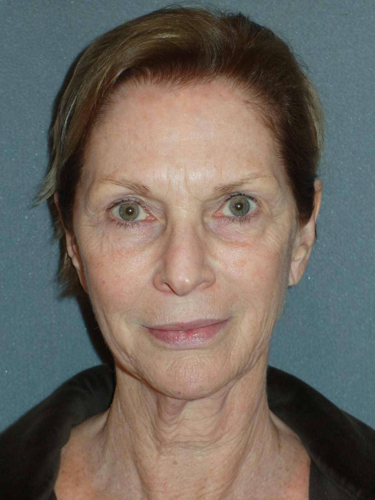 Lower Face & Neck Lifting Before & After Gallery - Patient 329261 - Image 1