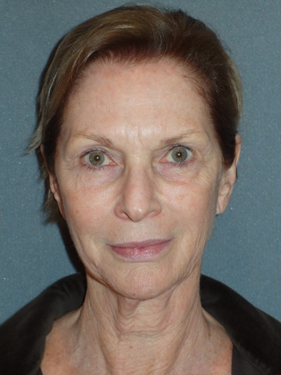 Lower Face & Neck Lifting Before & After Gallery - Patient 329261 - Image 1