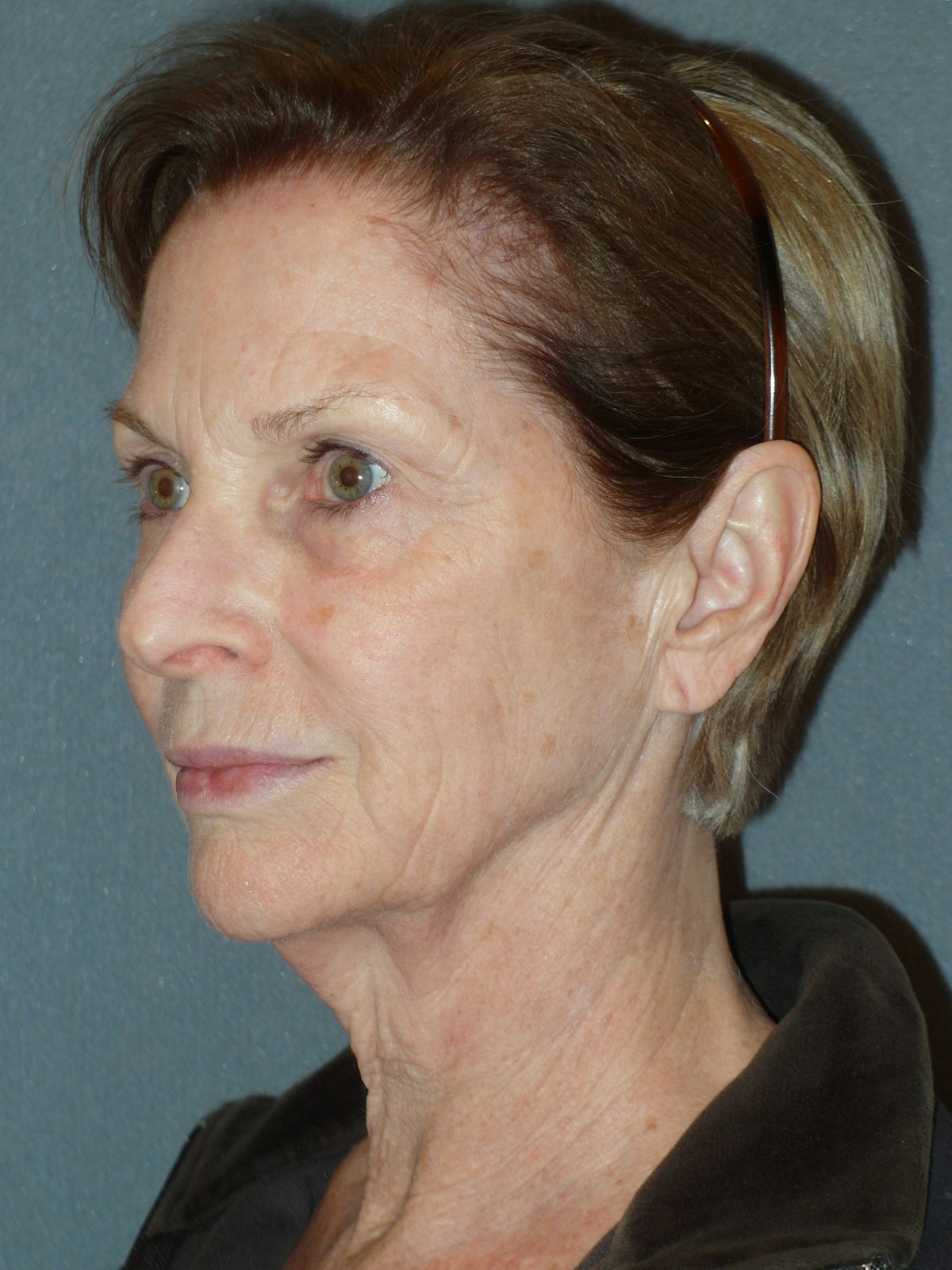 Lower Face & Neck Lifting Before & After Gallery - Patient 329261 - Image 7