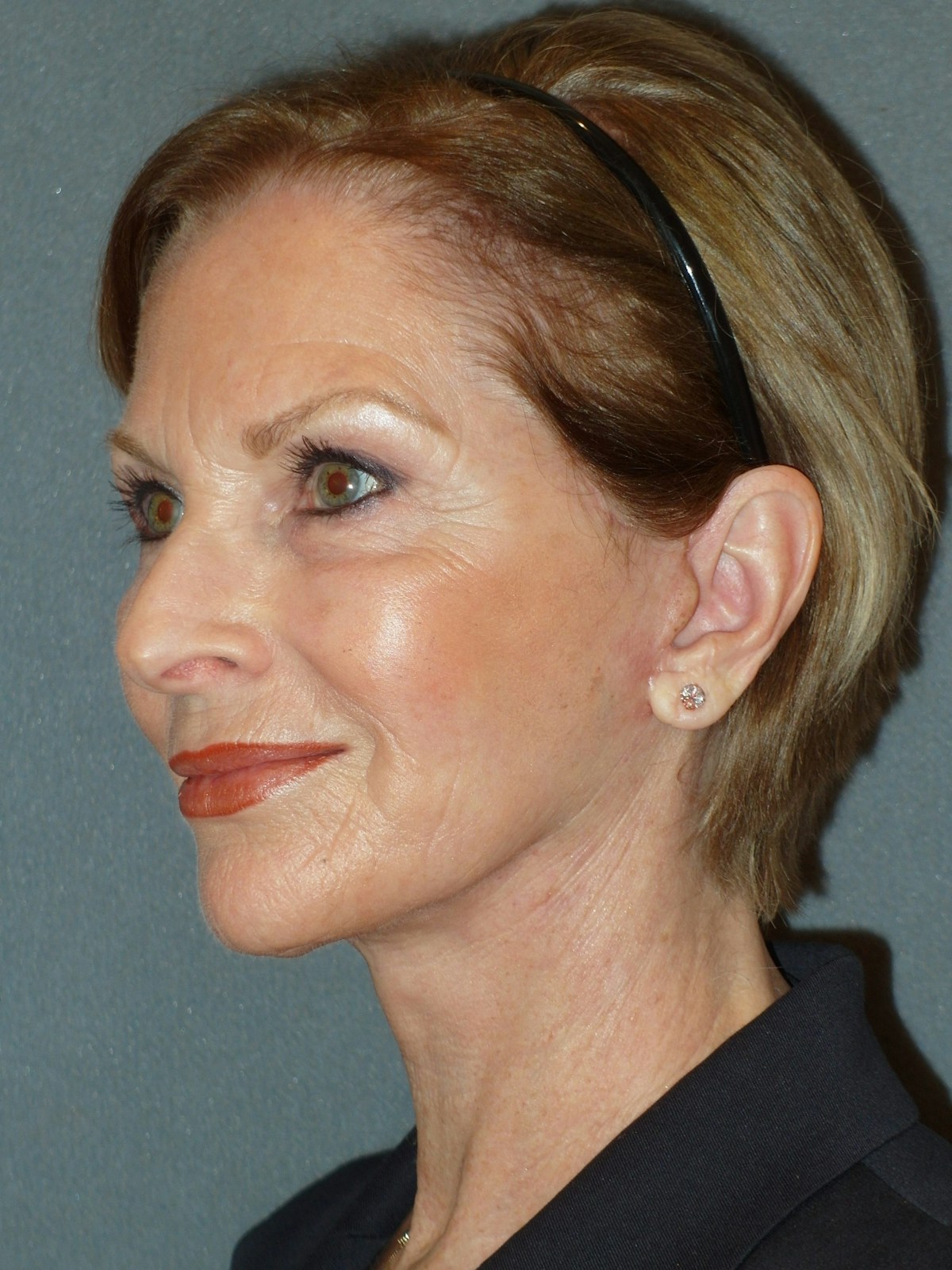 Lower Face & Neck Lifting Before & After Gallery - Patient 329261 - Image 8