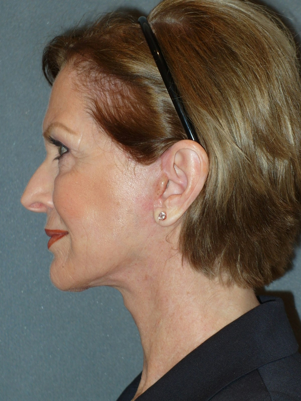 Lower Face & Neck Lifting Before & After Gallery - Patient 329261 - Image 10