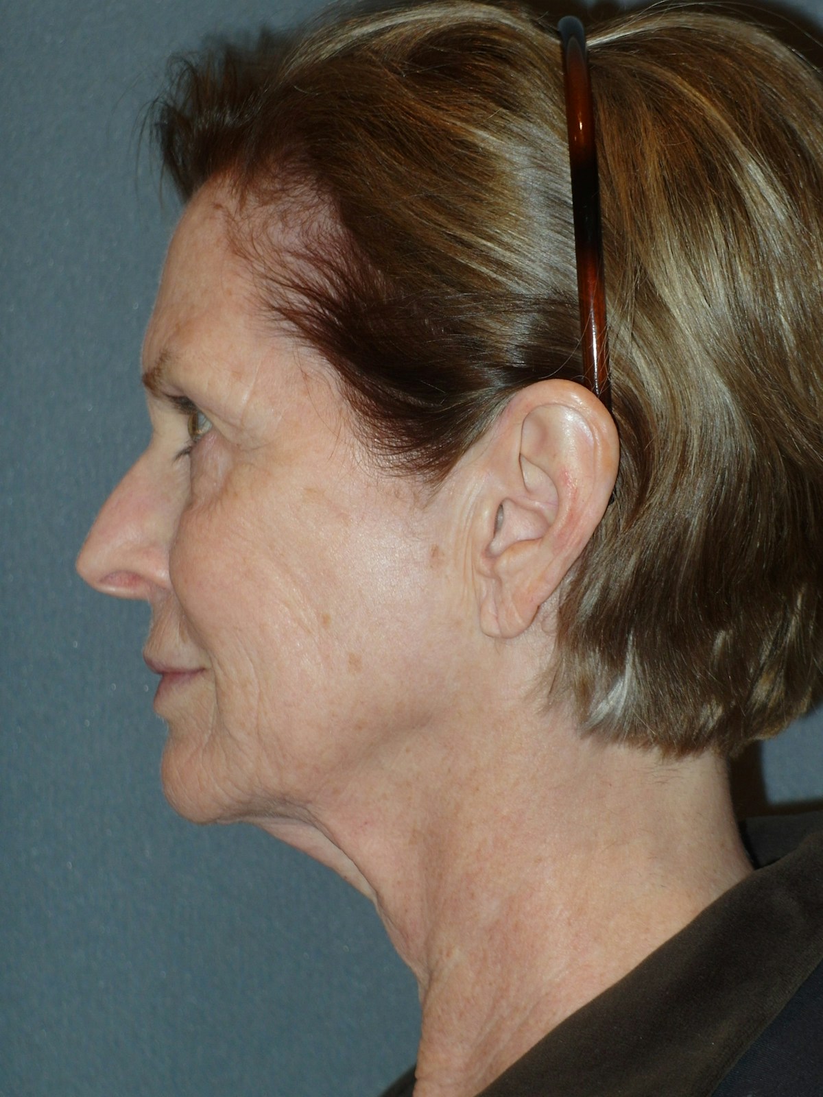 Lower Face & Neck Lifting Before & After Gallery - Patient 329261 - Image 9