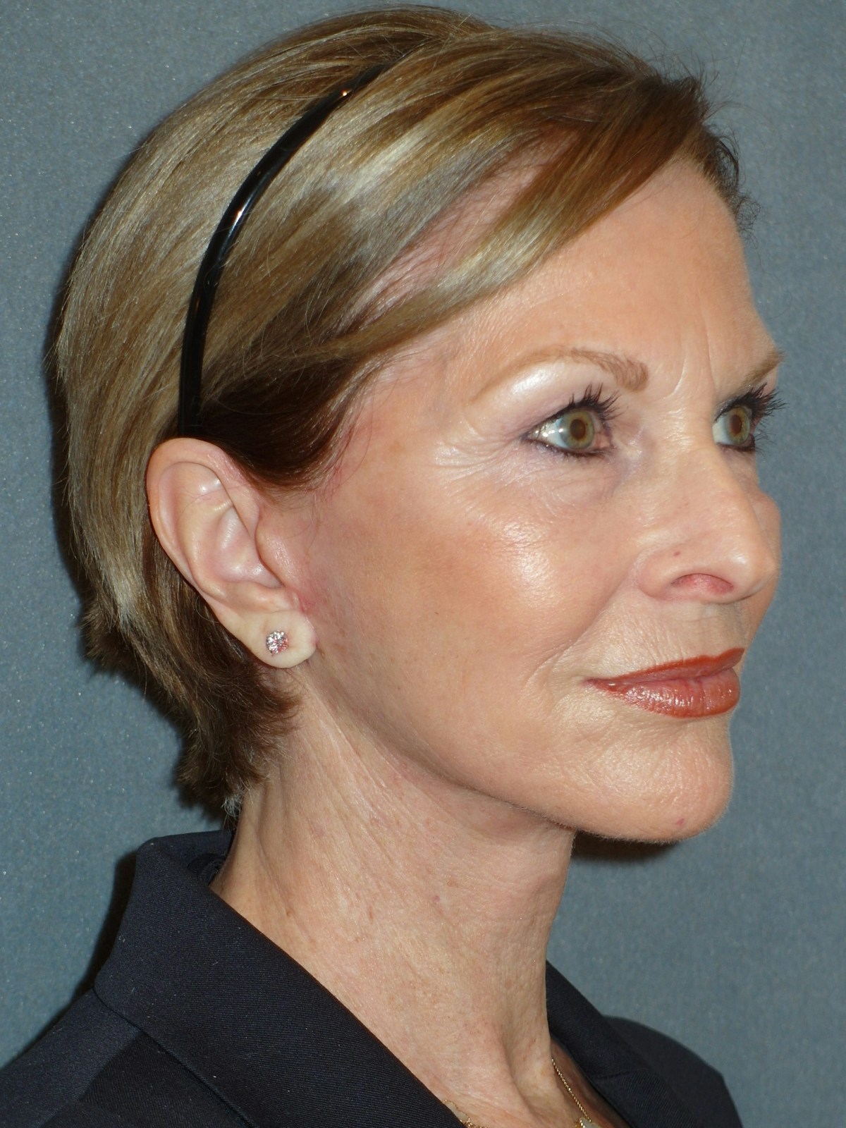 Lower Face & Neck Lifting Before & After Gallery - Patient 329261 - Image 4