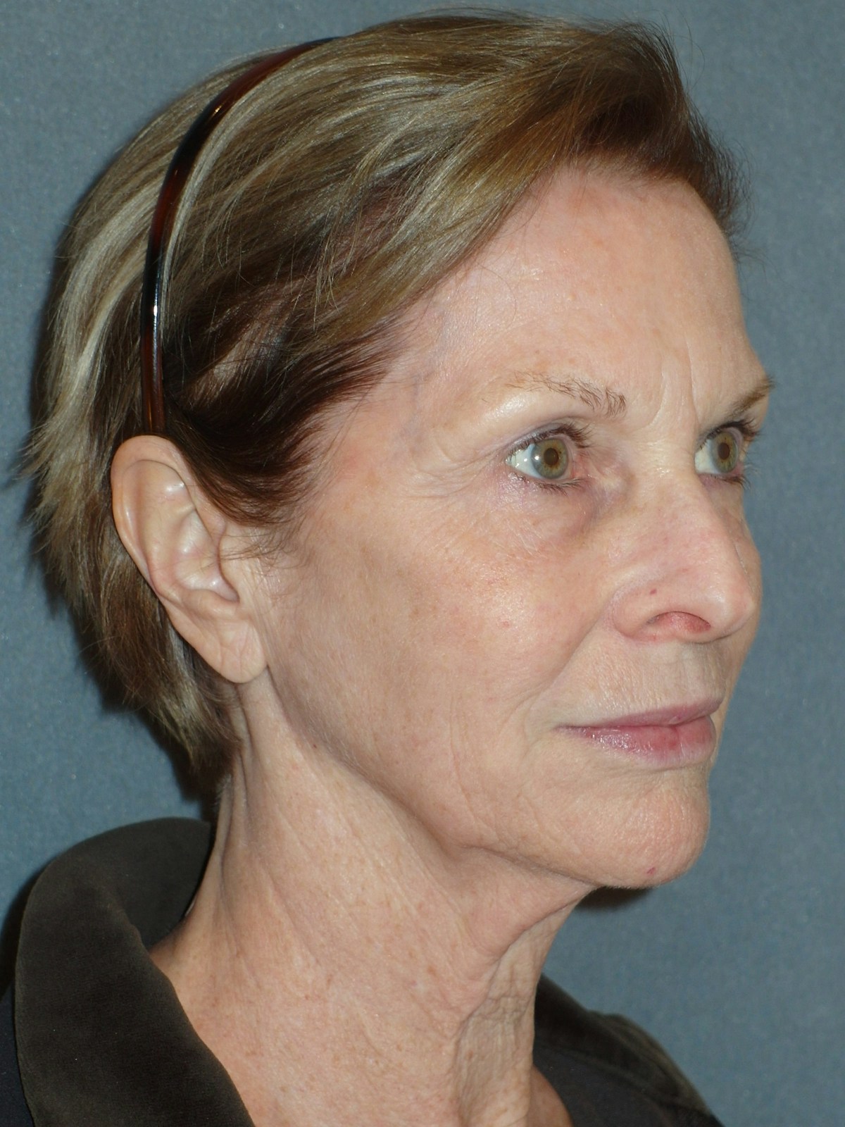 Lower Face & Neck Lifting Before & After Gallery - Patient 329261 - Image 3