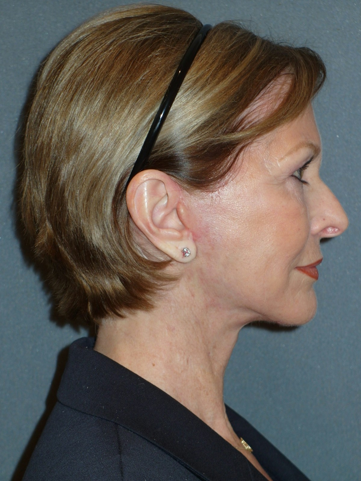 Lower Face & Neck Lifting Before & After Gallery - Patient 329261 - Image 6