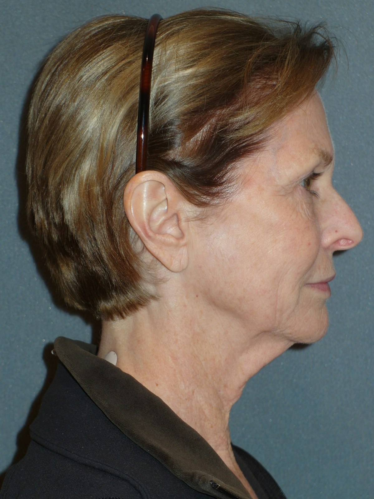 Lower Face & Neck Lifting Before & After Gallery - Patient 329261 - Image 5
