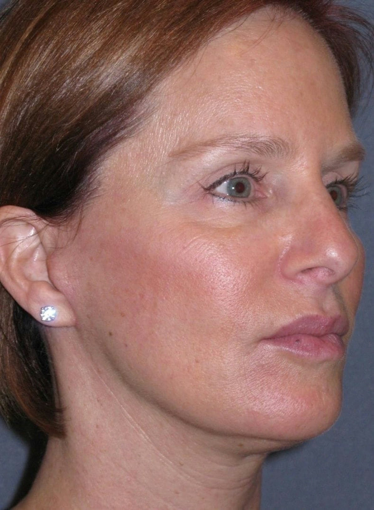 Mini Lift Before & After Gallery - Patient 159201 - Image 4