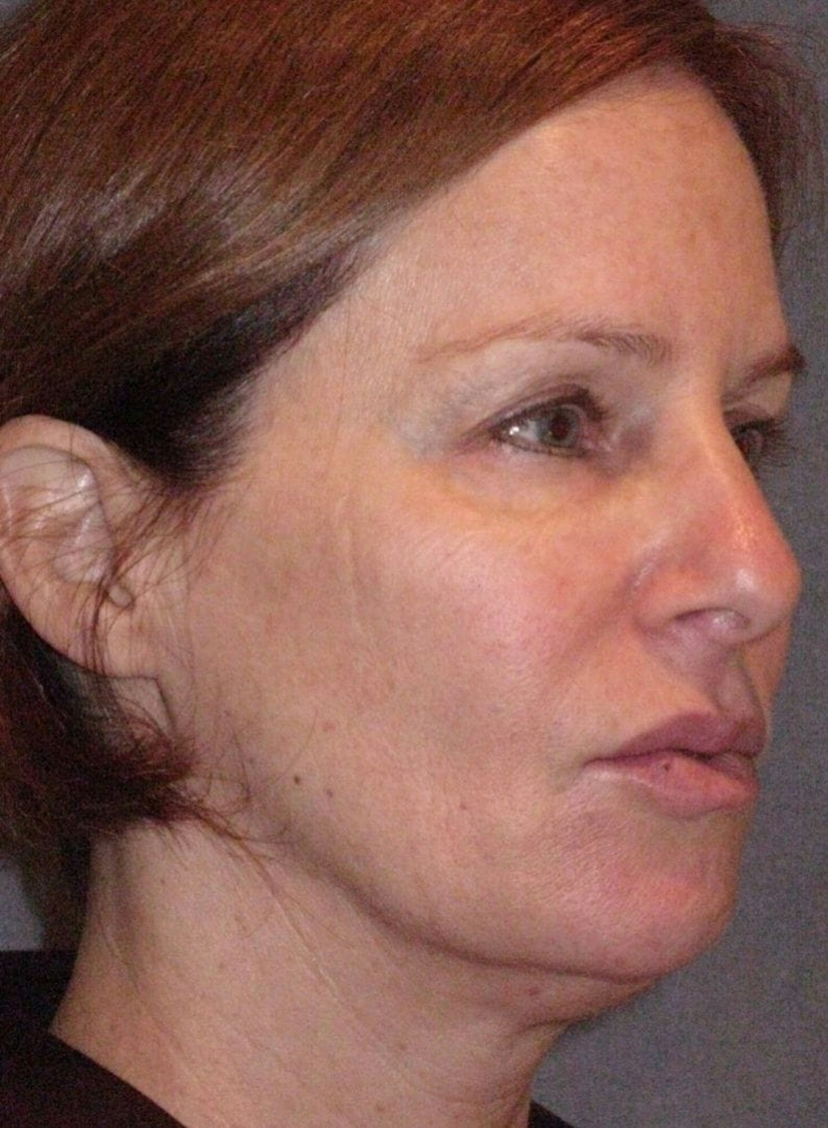 Mini Lift Before & After Gallery - Patient 159201 - Image 3