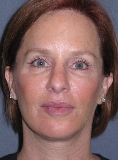 Mini Lift Before & After Gallery - Patient 159201 - Image 2