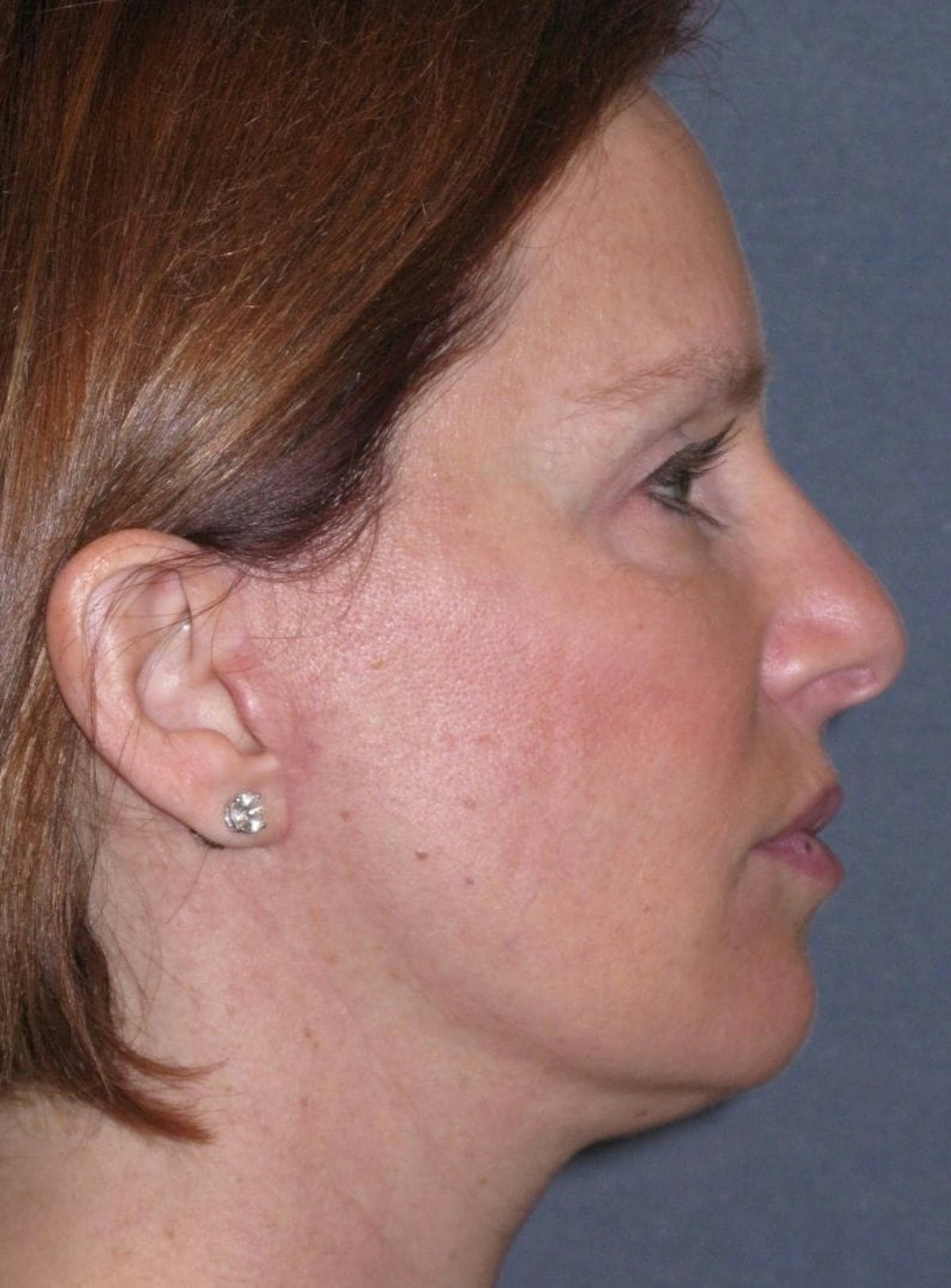 Mini Lift Before & After Gallery - Patient 159201 - Image 6