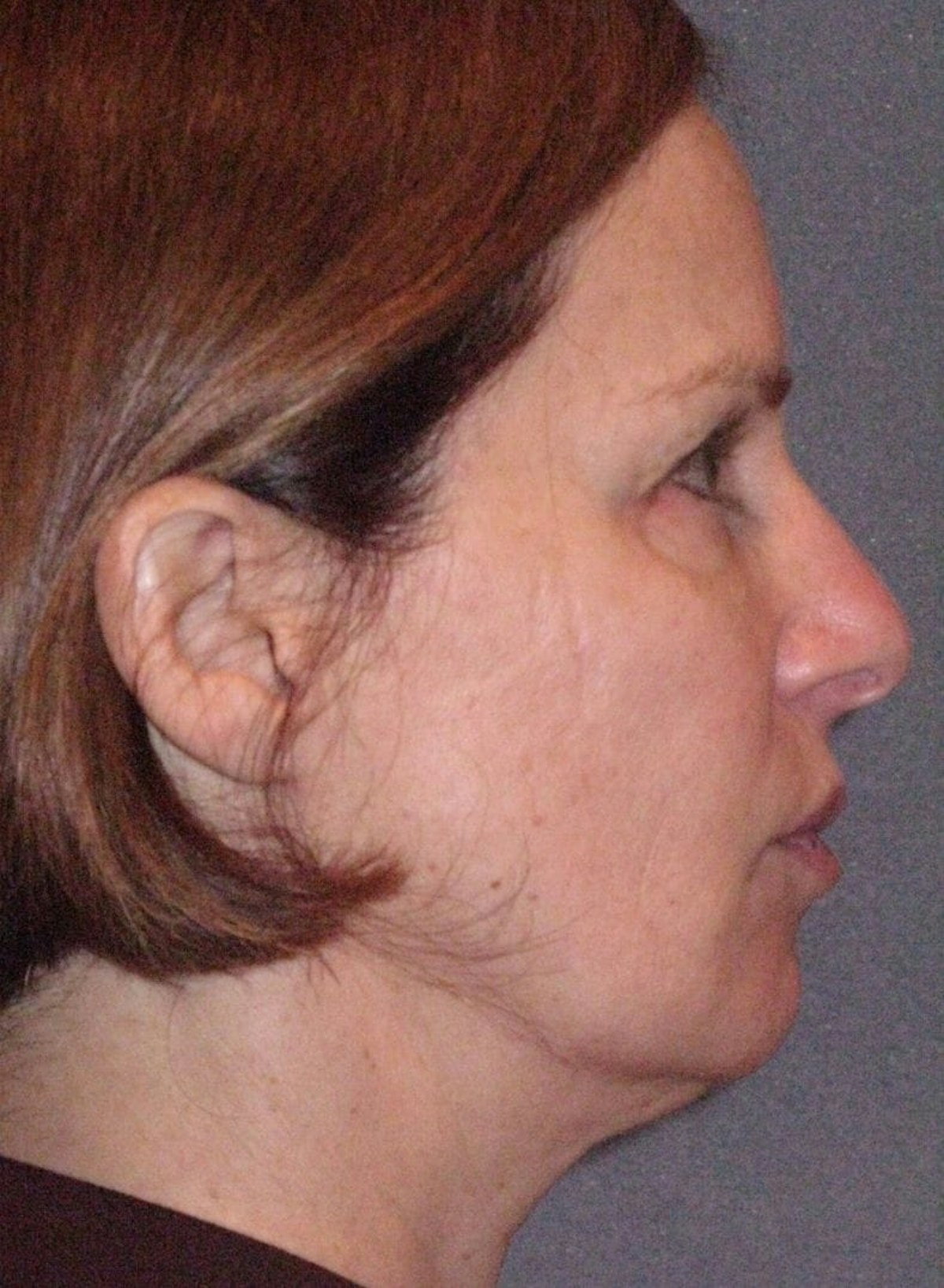 Mini Lift Before & After Gallery - Patient 159201 - Image 5