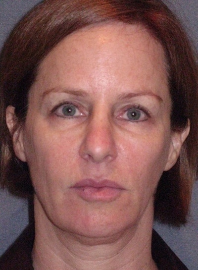 Mini Lift Before & After Gallery - Patient 159201 - Image 1