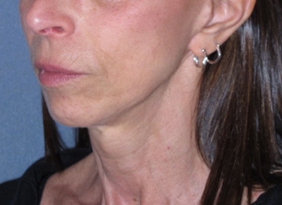 Mini Lift Before & After Gallery - Patient 105358 - Image 2