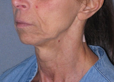 Mini Lift Before & After Gallery - Patient 105358 - Image 1