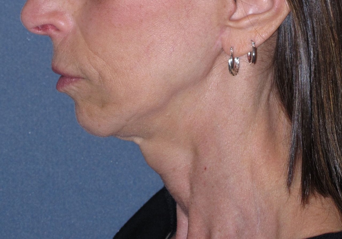 Mini Lift Before & After Gallery - Patient 105358 - Image 4