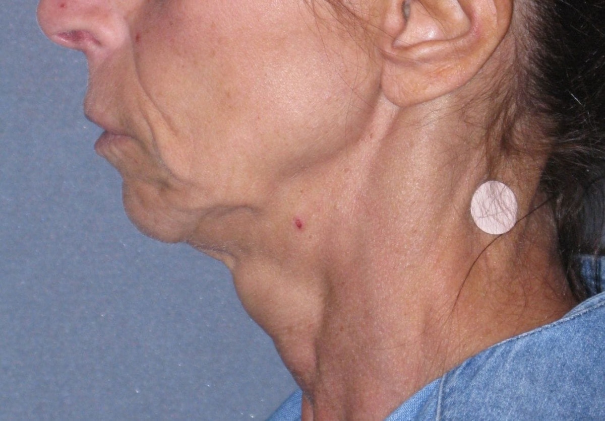 Mini Lift Before & After Gallery - Patient 105358 - Image 3