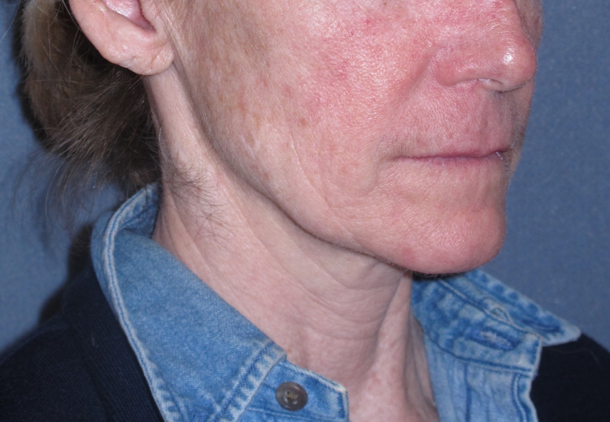 Mini Lift & Neck Lift Before & After Gallery - Patient 173042 - Image 3