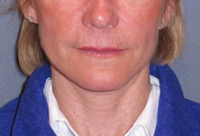 Mini Lift & Neck Lift Before & After Gallery - Patient 173042 - Image 2