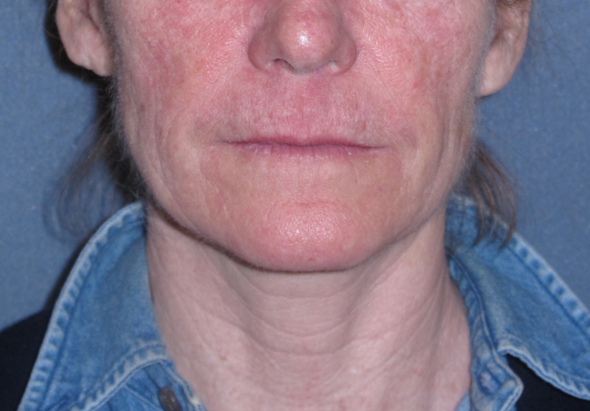 Mini Lift & Neck Lift Before & After Gallery - Patient 173042 - Image 1