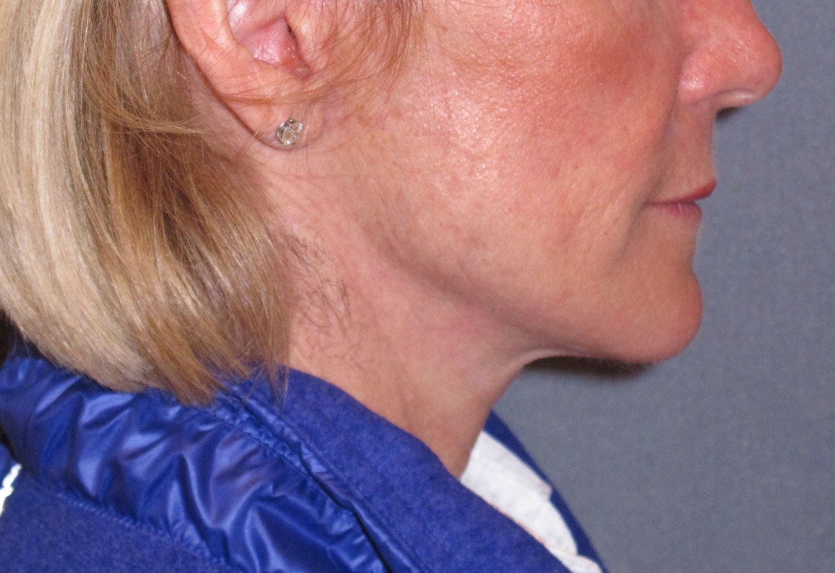 Mini Lift & Neck Lift Before & After Gallery - Patient 173042 - Image 6