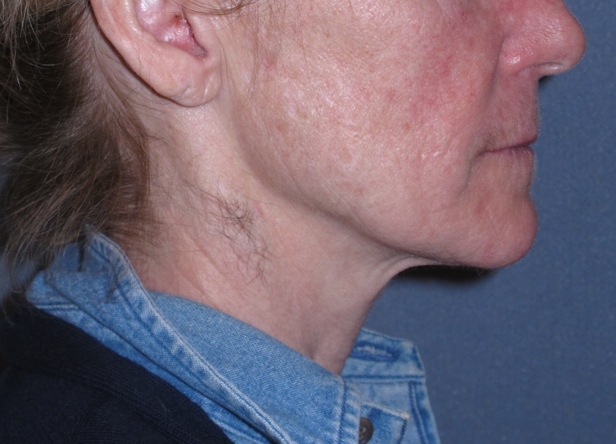 Mini Lift & Neck Lift Before & After Gallery - Patient 173042 - Image 5