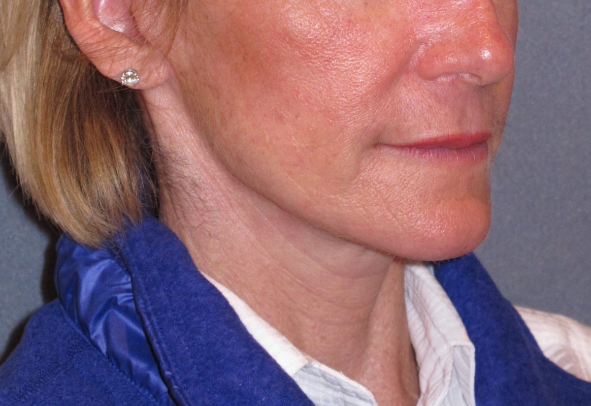 Mini Lift & Neck Lift Before & After Gallery - Patient 173042 - Image 4